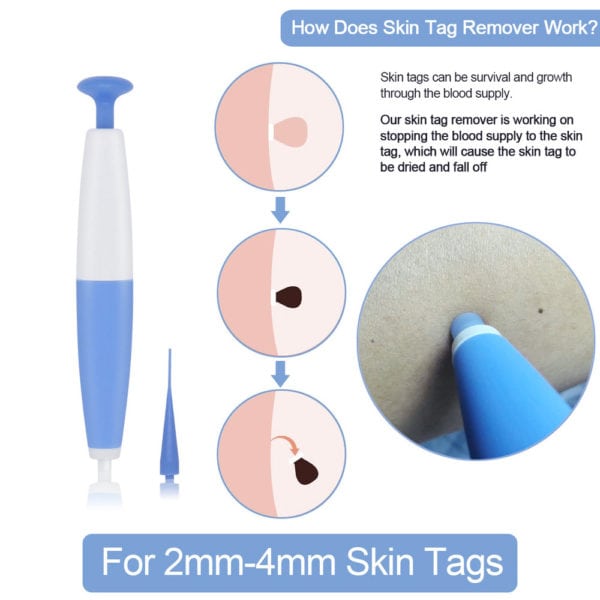 kit d'élimination de verrues – Image 2